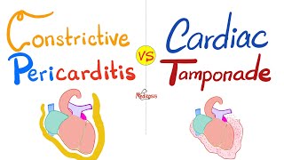 Constrictive Pericarditis vs Cardiac Tamponade  Cardiology Series [upl. by Aikemot]