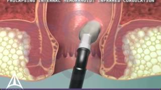 Infrared Coagulation Therapy for Hemorrhoids  3D Medical Animation [upl. by Follmer]