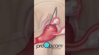 🩺 quotMaster Your Health Vaginal Hysterectomy Explained  PreOp® Patient Education shorts preop [upl. by Clarise]