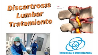 Espondiloartrosis lumbar tratamiento con ozono y Plasma Rico en Plaquetas [upl. by Oneida]