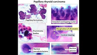 How to Diagnose Papillary Thyroid Carcinoma and its subtypes on Cytology [upl. by Beach]