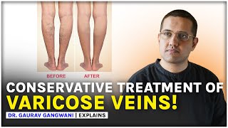 Varicose Veins Treatment Without Any Surgery  Dr Gaurav Gangwani Interventional Radiologist [upl. by Sualokcin]