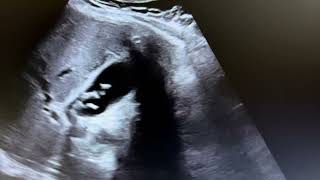 Ultrasound of calculus cholecystitis [upl. by Ecydnarb]