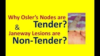 Why Oslers Nodes are Painful while Janeway Lesions are Painless [upl. by Mitchel]