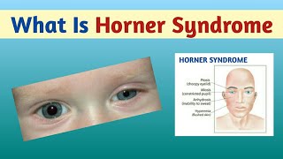 Horner Syndrome Causes Types Symptoms Diagnosis and Treatment  Pediatrics [upl. by Orman55]