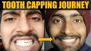 My TOOTH CAPPING Journey Cost Only Rs2000   From Broken Tooth To Get Fixed Properly [upl. by Swor]