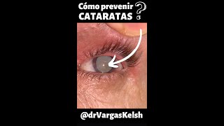 PREVENCIÓN de CATARATAS [upl. by Alexis301]