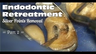 Endodontic Retreatment  Silver Points Removal Part 2 [upl. by Gambrell]