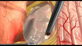 Animation  Spinal Cord Intramedullary Tumormov [upl. by Goddart]