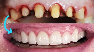 porcelain dental crowns and porcelain dental veneers before and after [upl. by Rita]