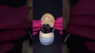 Dental Bridge Explained [upl. by Thanh]