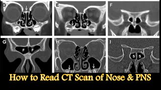 Nose and Paranasal Sinus CT Scan । How to Read । Coronal Axial amp Sagittal Scan Explained [upl. by Ruder]