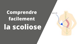 Comprendre facilement la scoliose  que signifie déformation vertébrale dans les 3 plans🤔 [upl. by Ahseile]