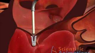 Cardiology  Mitral Valve Clip [upl. by Eelyr983]