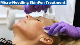 MicroNeedling Skin Pen Treatment amp Benefits [upl. by Luht312]