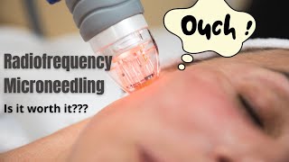 Radiofrequency Microneedling  Does it actually work  Dermatologist reviews [upl. by Jarlath]