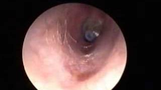 Otitis media Serosa Diagnostico y resolucion Quirurgica [upl. by Ocer]