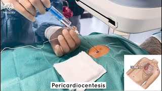 Pericardiocentesis [upl. by Fisa969]