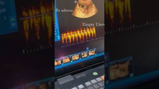 Unruptured Live Ectopic Pregnancy ectopicpregnancy ultrasonography [upl. by Percy]