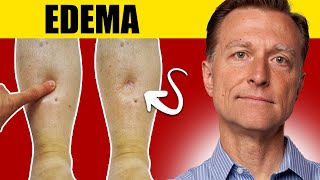 8 Surprising Causes of Edema Uncover the Truth [upl. by Benita]