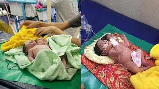 Tak Pernah Lakukan USG Ibu Kaget Melahirkan Bayi Kembar Siam 1 Badan 2 Kepala [upl. by Ennayhs955]