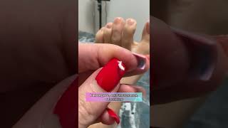 СКРУЧЕННЫЙ НОГОТЬ ПОЧЕМУ ТАМПОНАДА ВРОСШЕГО НОГТЯ CURLED NAILWHY TAMPONADE OF AN INGRONED NAIL [upl. by Lledniw]