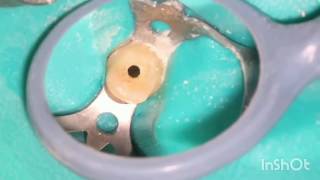 Root canal treatment full step by step [upl. by Okiek247]