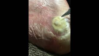 Plantar Wart With DuckTape [upl. by Hamaso52]