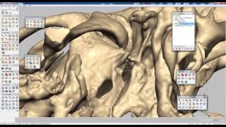 Geomagic Freeform  Reconstruccion de Protesis Mandibula [upl. by Scheld]