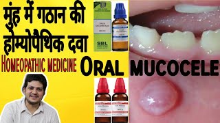 Mucocele  Homeopathic medicine for Oral mucocele [upl. by Bobby538]