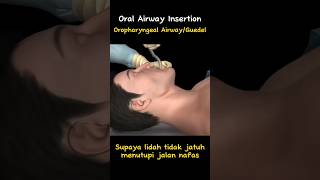 Oropharyngeal Airway [upl. by Reifinnej]