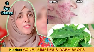 14 Days Challenge  No More ACNE Pimples amp Dark Spots  Get FAIR amp Flawless Skin [upl. by Binette]