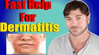 Fast Help For Seborrheic Dermatitis  Face and Scalp  Chris Gibson [upl. by Aiselad]