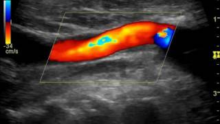 CAROTID DUPLEX CCA TO SUBCLAVIAN ARTERY BYPASS [upl. by Olegnaed]