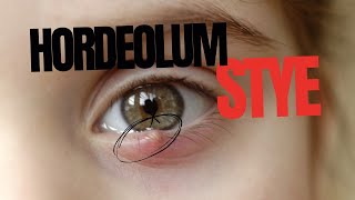 Stye Hordeolum [upl. by Oznecniv]