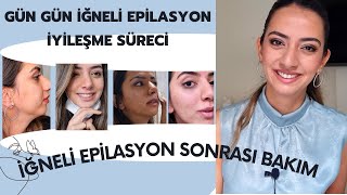 İĞNELİ EPİLASYON İYİLEŞME SÜRECİ  İĞNELİ EPİLASYON SONRASI BAKIM İZ KALIR MI YÜZ TÜYLERİ KURTULMA [upl. by Gloriana]