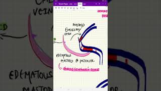 Lateral Sinus Thrombophlebitis Syn Sigmoid Sinus Thrombosis made easy ✨ [upl. by Ben898]