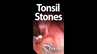 Tonsil stones forming in a large tonsil fissure [upl. by Htebazileyram176]