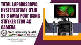 Total Laparoscopic Hysterectomy TLH by 3 5mm Port Using Stryker 1788 4K Camera at WLH [upl. by Oileve886]