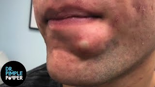 SATISFYING Dr Lee Pops Inflamed Cyst on Chin  Dr Pimple Popper Reacts [upl. by Gladys]