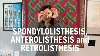 Spondylolisthesis anterolisthesis and retrolisthesis explained by Irvine Chiropractor [upl. by Nalniuq977]