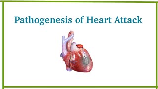 Pathogenesis of myocardial infarction  Heart Attack  Cardiovascular system pathology  Dr Med [upl. by Ardnoet]