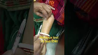 Mantoux test TB ka test skin test shorts short video [upl. by Viviyan913]