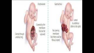 Omphalocele vs Gastroschisis [upl. by Lertsek]