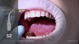 PROPHYLAXIS  Dr Daniele Brondo  Supragingival scaling and airpolishing [upl. by Nerek]