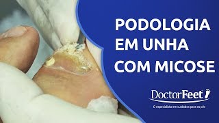 PODOLOGIA EM UNHA COM MICOSE [upl. by Menides315]