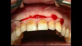 Gingival Surgery  External Bevel [upl. by Anowahs149]