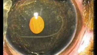 Angiostrongylus nematode worm in eye of puppy  surgical removal [upl. by Mattie]