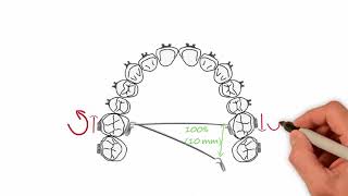 Transpalatal Arch Activations  Essential Biomechanics [upl. by Annay]