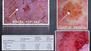 Lip Squamous Cell Carcinoma  Dr Caterina Longo [upl. by Armstrong821]